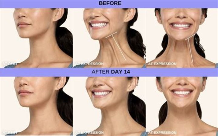 Can botox help neck bands?