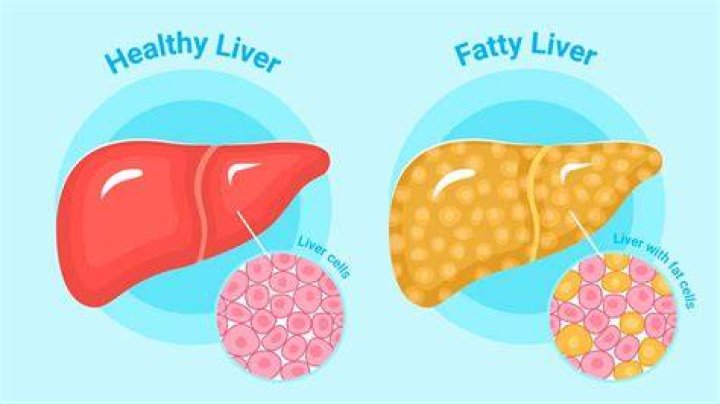 Can fatty liver be cured?