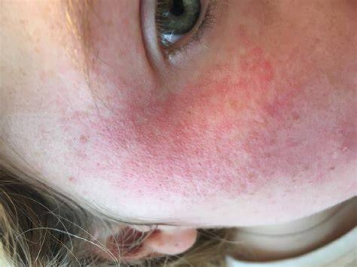 Can you be allergic to mascara?