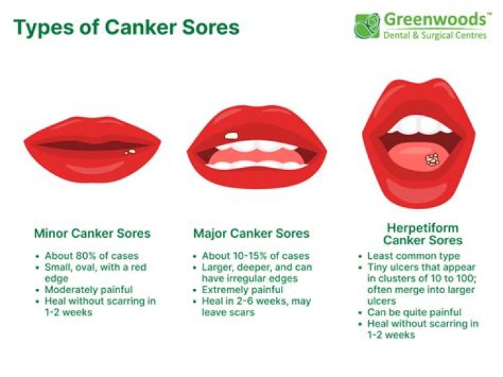 Do cankers always hurt?