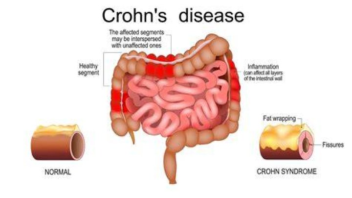 Do crohn's symptoms come and go?