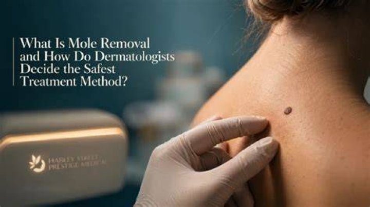 Do dermatologists remove moles?