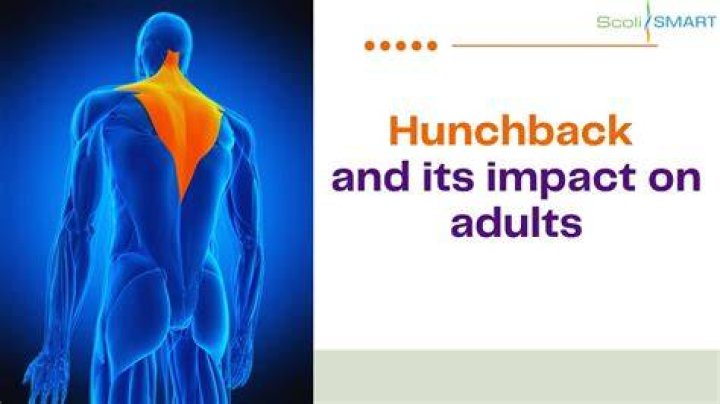 Do hunchbacks still exist?