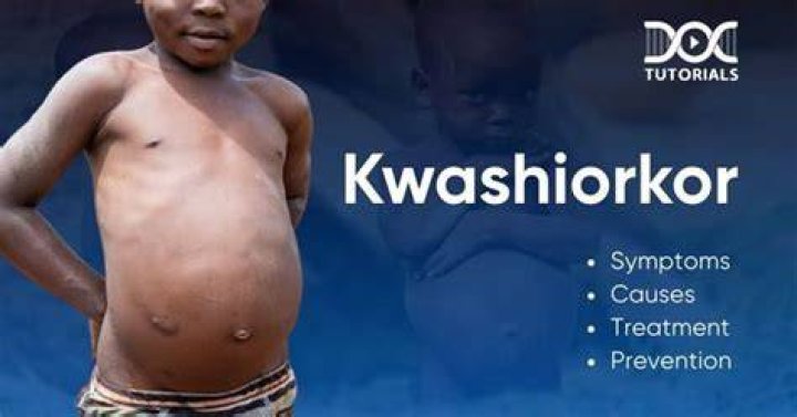 Do i have kwashiorkor?