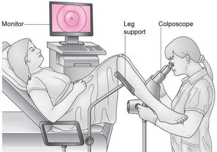 Do you always have a biopsy with a colposcopy?