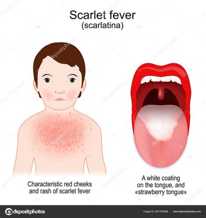 Does scarlatina go away?