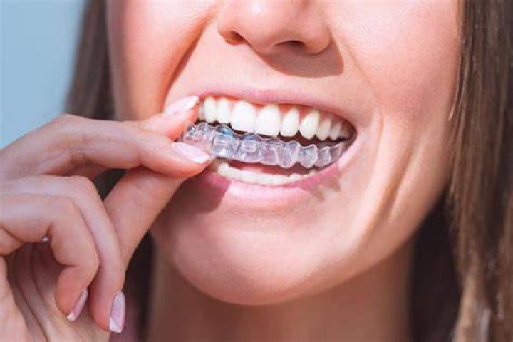 How aligners should fit?