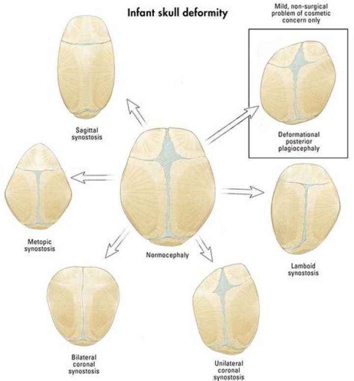 How common is craniosynostosis?