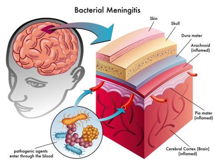 How do you get leptomeningitis?