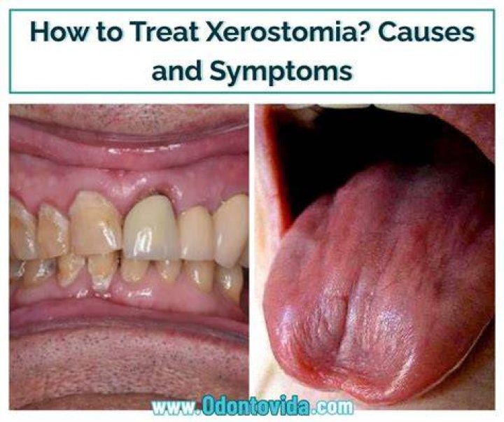 How to treat xerostomia?