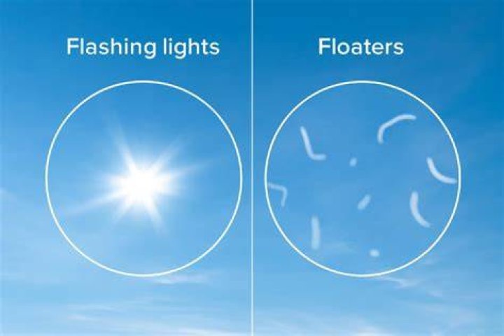 Is it normal to see floaters in bright light?