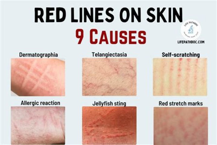 What does red streaking mean?