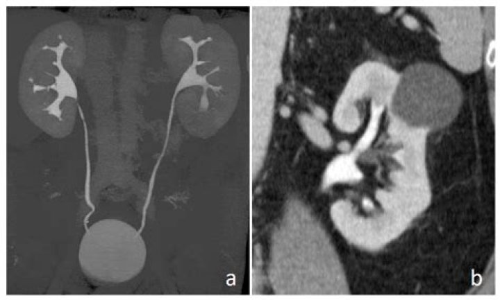 What is a uro ct scan?