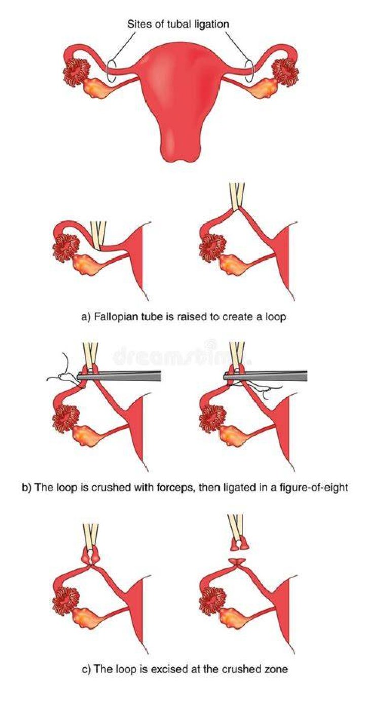 What is fulguration of fallopian tubes?
