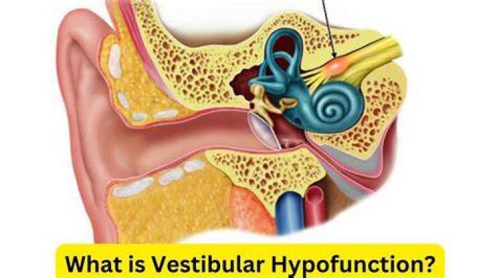 What is peripheral vestibular hypofunction?