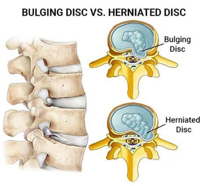 Whats the difference between bulging and herniated discs?