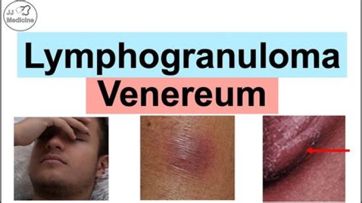 When do lymphogranuloma venereum symptoms appear?