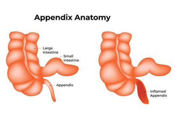 Where exactly is your appendix?