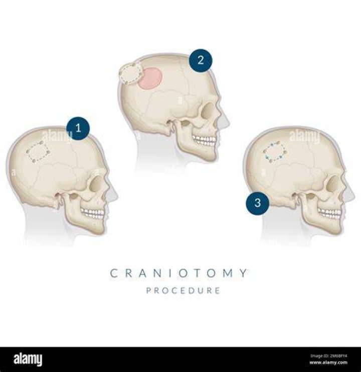 Where is craniotomy located?