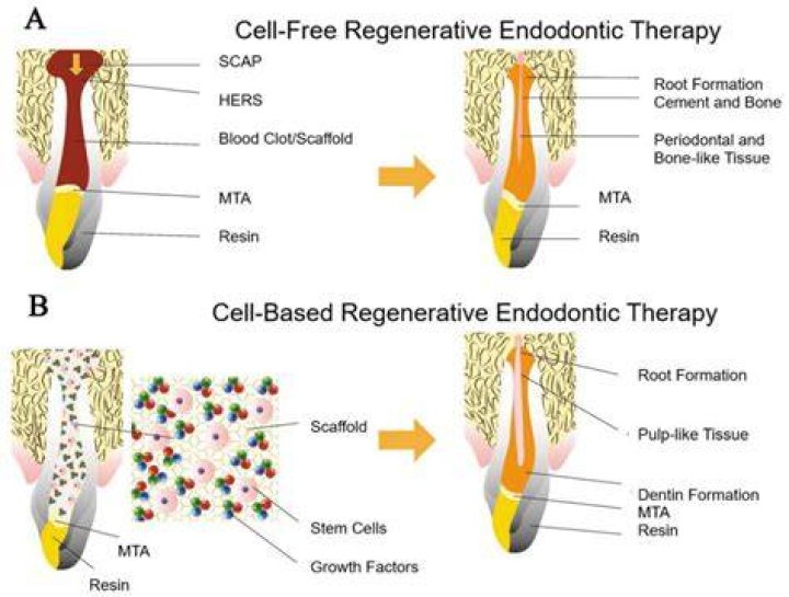 Who invented regenerative endodontics?