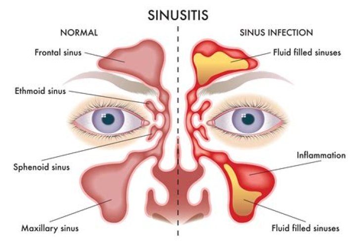 Why maxillary sinusitis is common?
