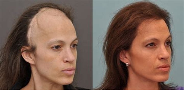 Will hair grow back after brain surgery?
