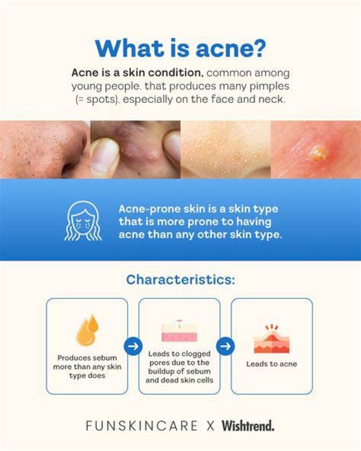 Will i always have acne prone skin?