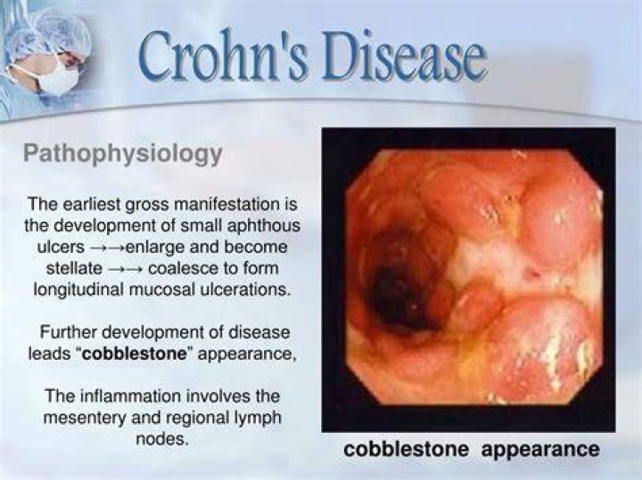 Would colonoscopy show crohn's disease?
